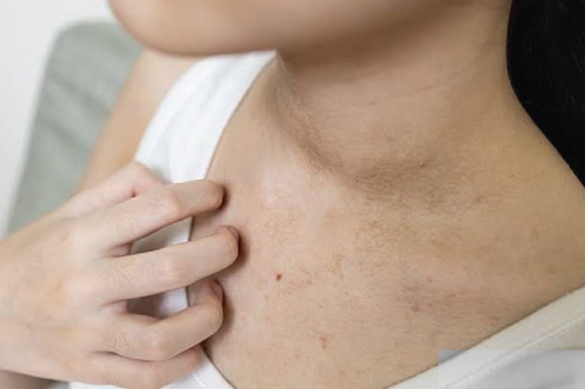 Bercak Hitam di Leher Bukan Daki, Melainkan Tanda Resistensi Insulin